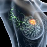 Le Sénégal a besoin de personnels et de moyens pour lutter contre le cancer