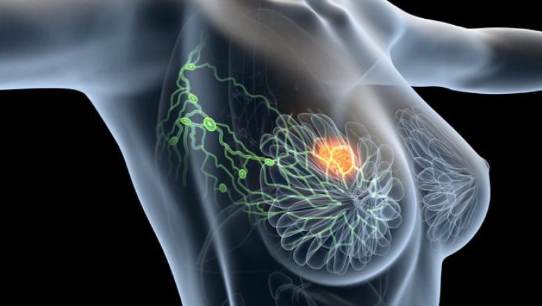 Le Sénégal a besoin de personnels et de moyens pour lutter contre le cancer